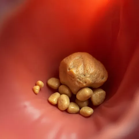 Jak szybko rośnie kamień w woreczku żółciowym